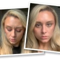 How Long Does it Take to See Results After Botox Injections?