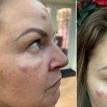 Why Some People Don't Respond to Botox