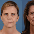 Can Botox Treat Facial Paralysis and Synkinesis?