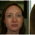 Is Botox or Filler Better for Jawline Enhancement?