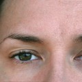 What are the Health Risks of Botox Injections?