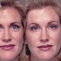 How Long Does It Take for Botox to Work for Eyebrow Lift?