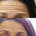 How to Shorten the Effects of Botox