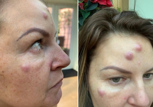 Why Some People Don't Respond to Botox