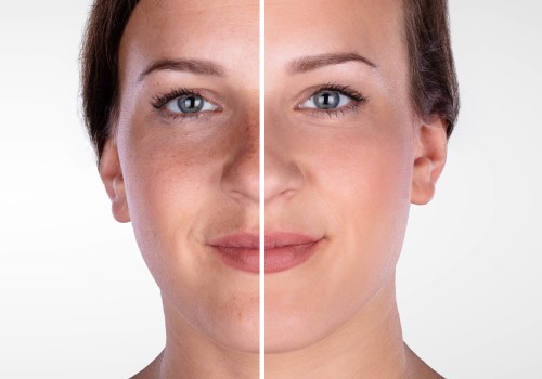 Who is Most Qualified to Administer Botox Injections?