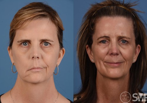 Can Botox Treat Facial Paralysis and Synkinesis?