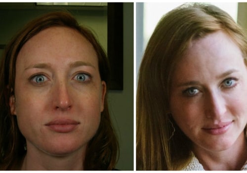 Is Botox or Filler Better for Jawline Enhancement?