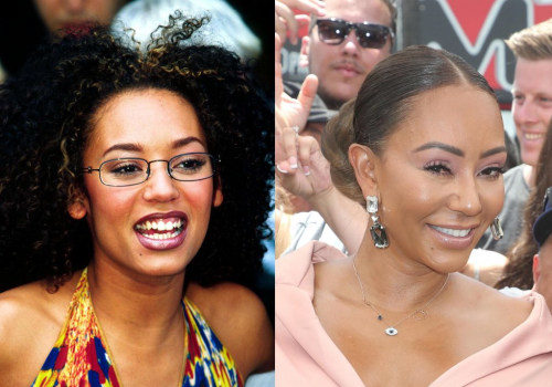 Is Botox Harmful in the Long-Term?