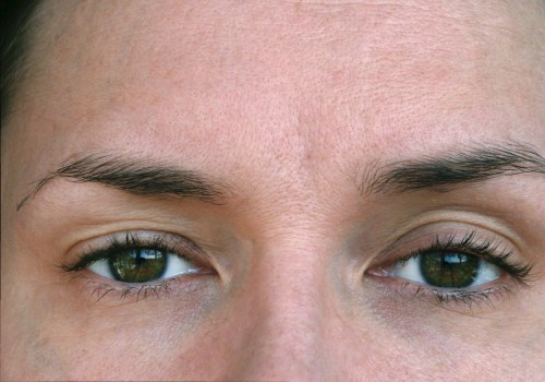 When do Botox Side Effects Disappear?
