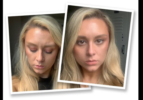 Can You See Botox Results in 4 Days?