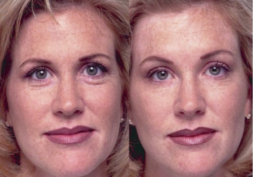How Long Does It Take for Botox to Work for Eyebrow Lift?