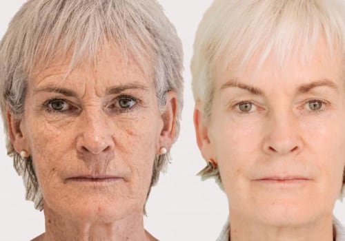 Can Botox Get Rid of Sagging Jowls?