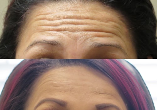 How to Shorten the Effects of Botox